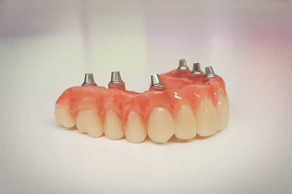 Things To Know About Implant Supported Dentures