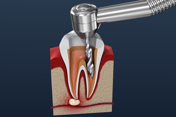 Indications For A Root Canal: What To Look Out For